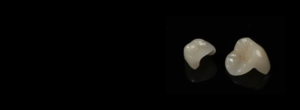 Full Inlay Inlays and Onlays – Full Service Dental Lab